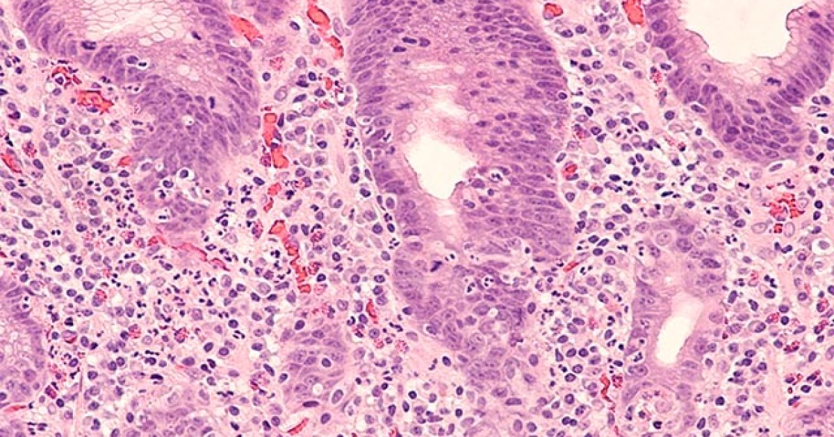 lieknamatrix-sk-helikobakter-featured